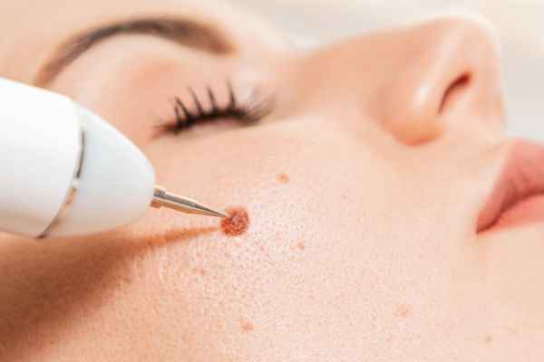 CryoPen: 5 Skin Concerns It May Be Used to Treat 3 What actually happens during a CryoPen treatment Braintree?