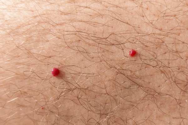 CryoPen: 5 Skin Concerns It May Be Used to Treat 2 cherry angioma removal Braintree